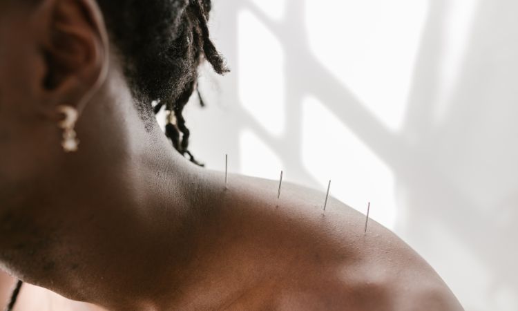 Acupuncture